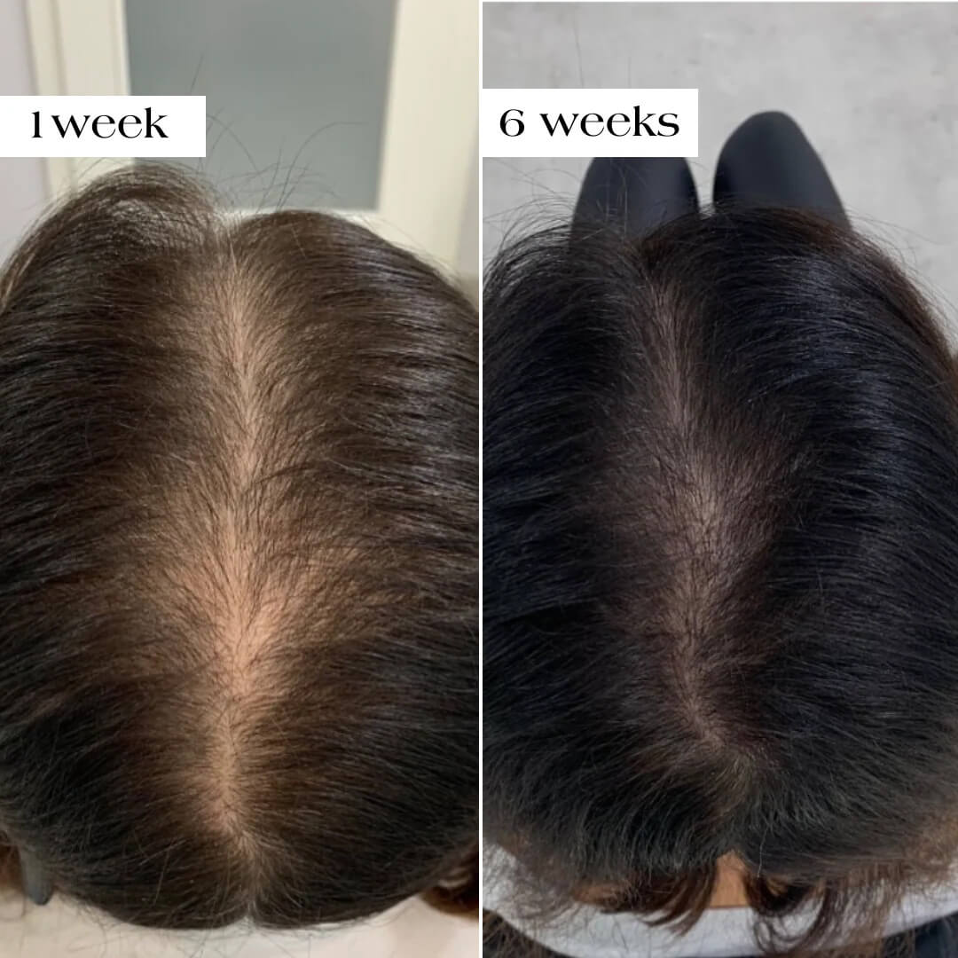 ThickBloom™ Hair Growth